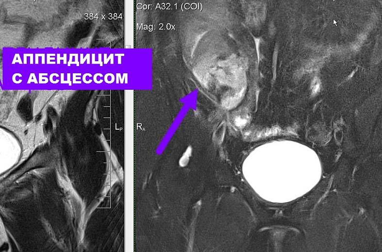 МРТ органов брюшной полости и холангиография (детальный осмотр внутри и вне печеночных желчных протоков)