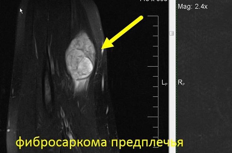 МРТ плечевого сустава