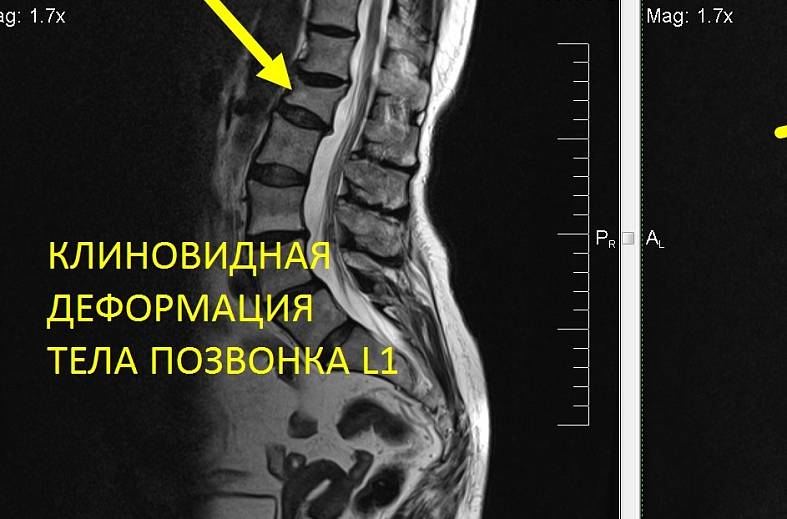 МРТ пояснично-крестцового отдела позвоночника