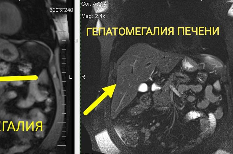МРТ органов брюшной полости и холангиография (детальный осмотр внутри и вне печеночных желчных протоков)