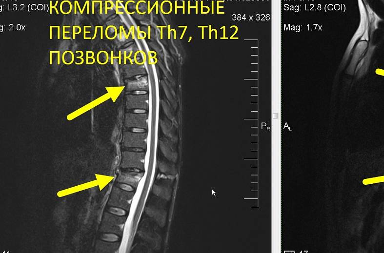 МРТ всего позвоночника (осмотр по ТИМ технологии)
