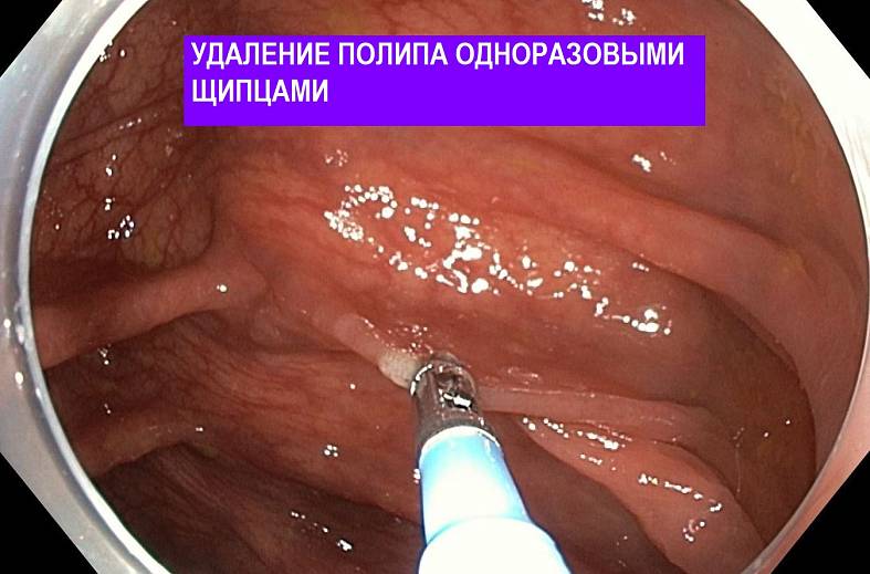 Видеоколоноскопия экспертного класса на аппарате Pentax i7010 (Япония) expert