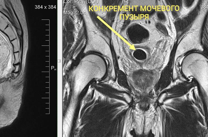 Диффузно-взвешенное магнитно-резонансное изображение (DWI MRI) ( для обеспечивания контрастности картинки)