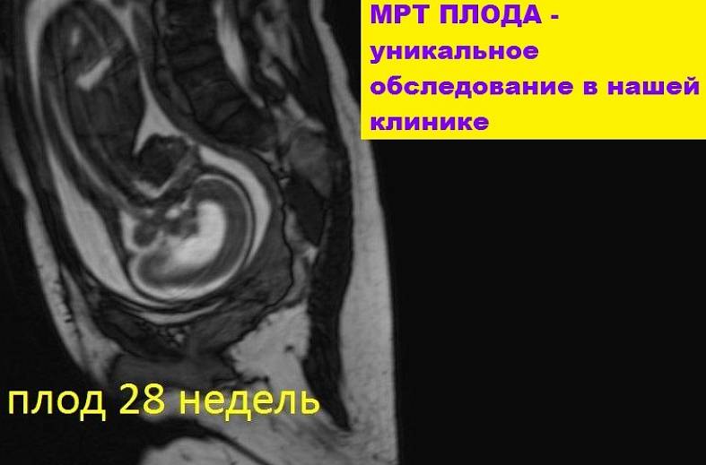МРТ беременности с 22 недели (пороки развития плода, патология матери, определение пола)