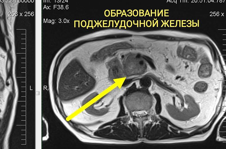 МРТ органов брюшной полости (печень, поджелудочная железа, селезенка, желчный пузырь, нижняя полая вена, брюшной отдел аорты, лимфатические узлы)