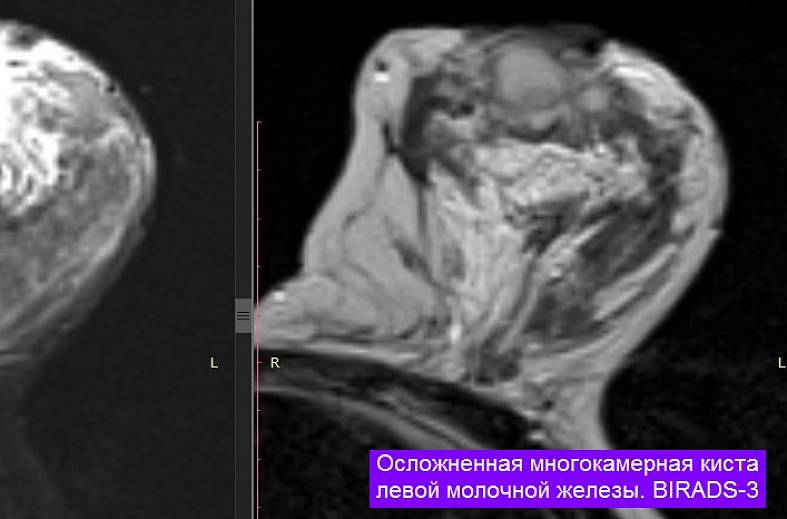 МРТ-исследование молочных желез + контрастирование