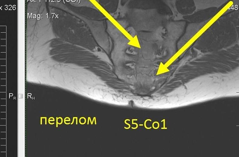 МРТ пояснично-крестцового и крестцово-копчикового отдела позвоночника