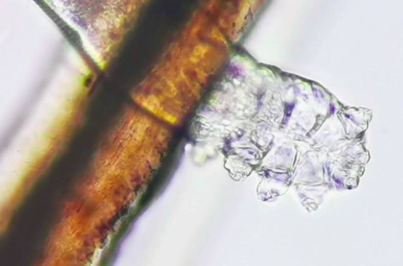 Обследование и забор материала на Демодекоз (Demodex)