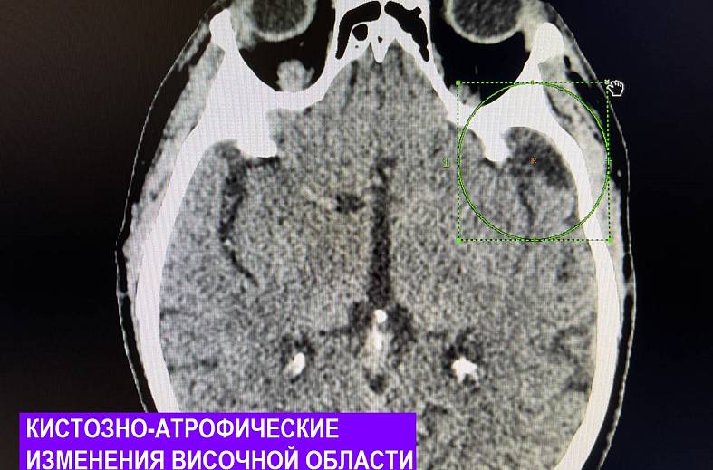 КТ головного мозга