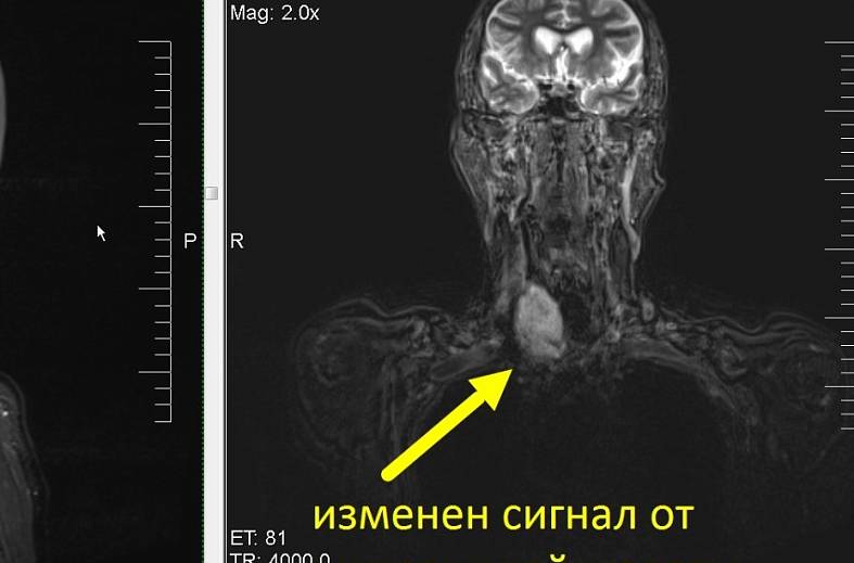 МРТ исследование щитовидной железы