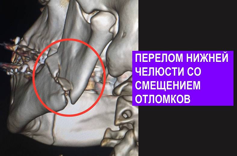 КТ лицевого скелета