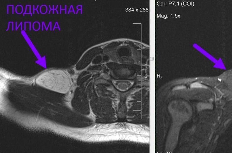МРТ мягких тканей конечности (одна область)