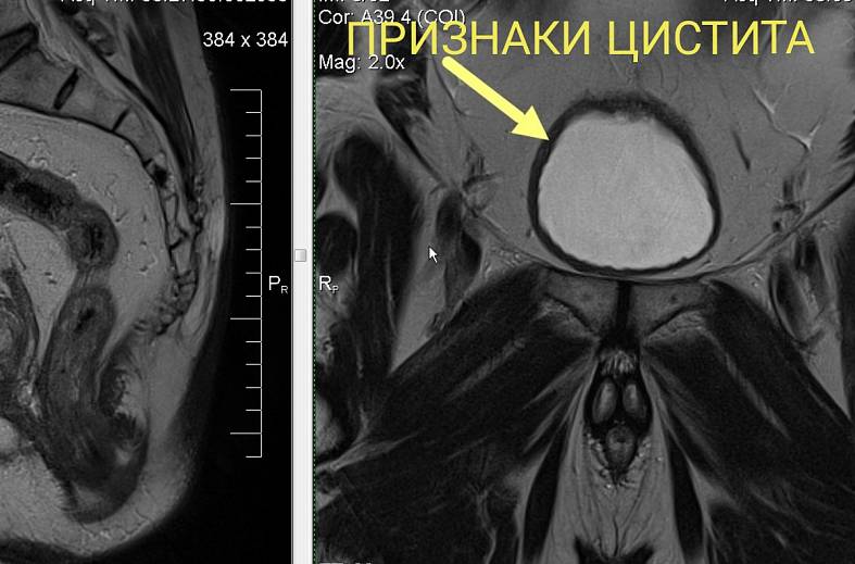 Диффузно-взвешенное магнитно-резонансное изображение (DWI MRI) ( для обеспечивания контрастности картинки)