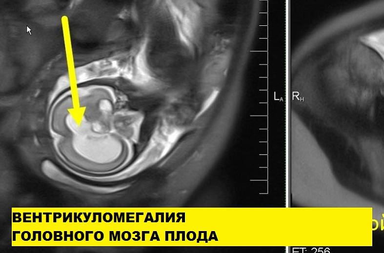 МРТ беременности с 22 недели (пороки развития плода, патология матери, определение пола)
