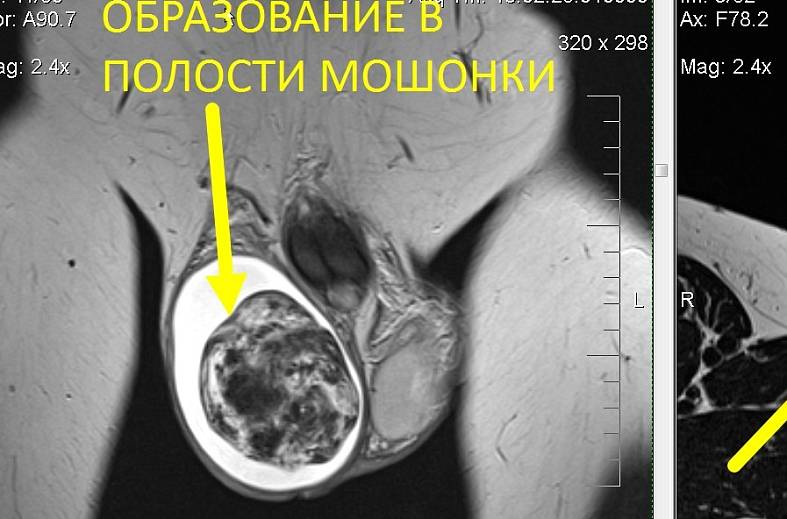 МРТ наружных половых органов (органы мошонки и пенис)