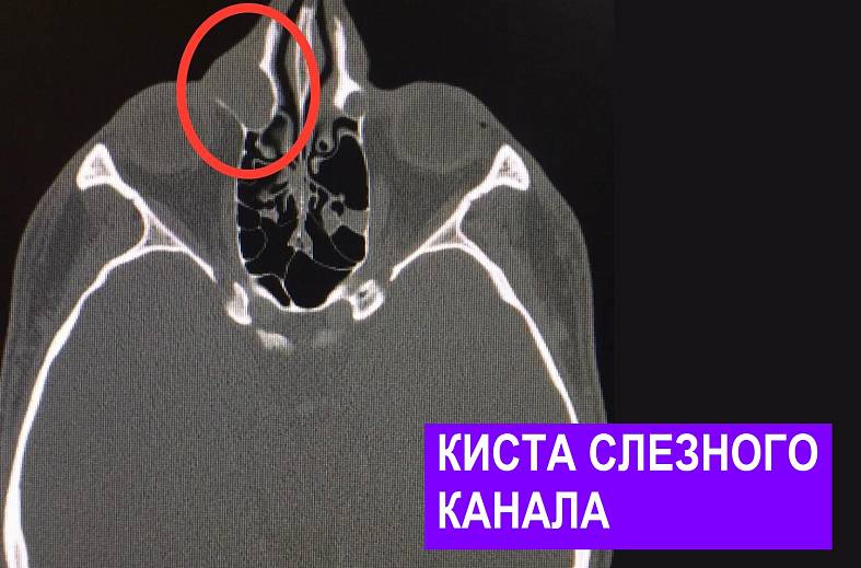 КТ глазных орбит