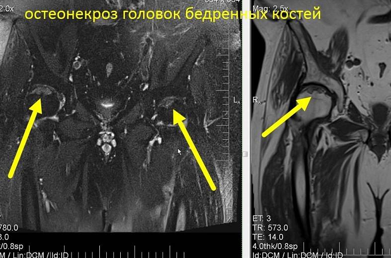 МРТ тазобедренных суставов (пара суставов)
