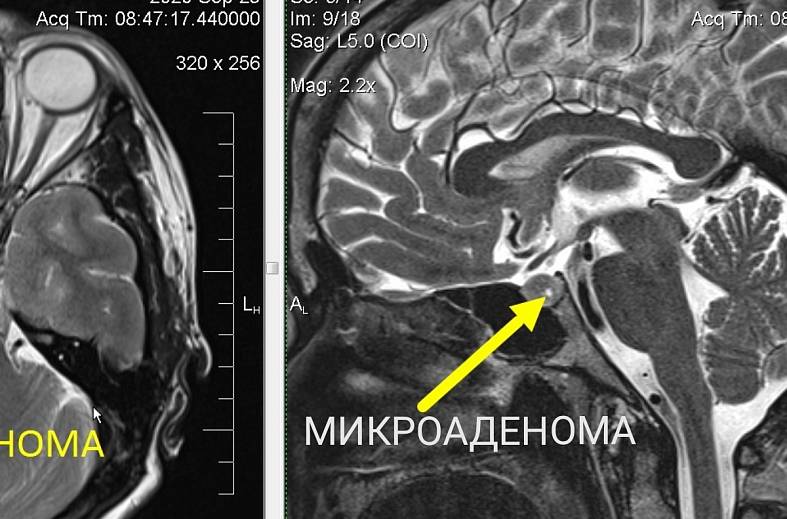 МРТ гипофиза 