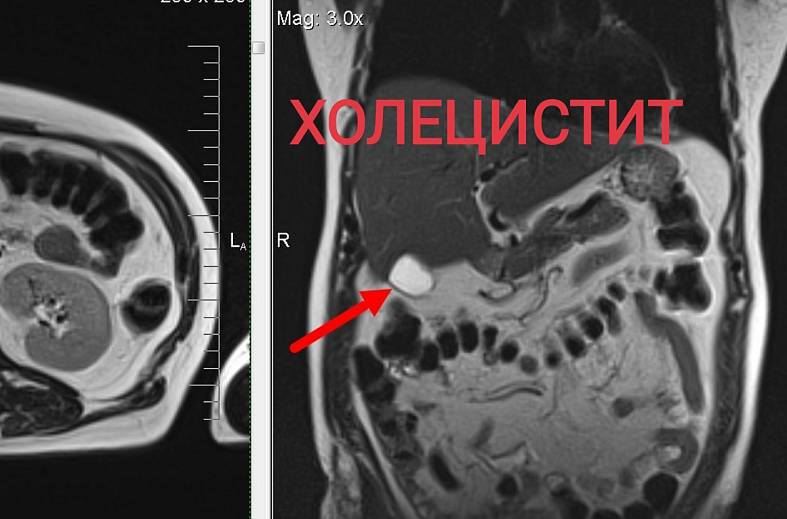 МРТ органов брюшной полости и холангиография (детальный осмотр внутри и вне печеночных желчных протоков)