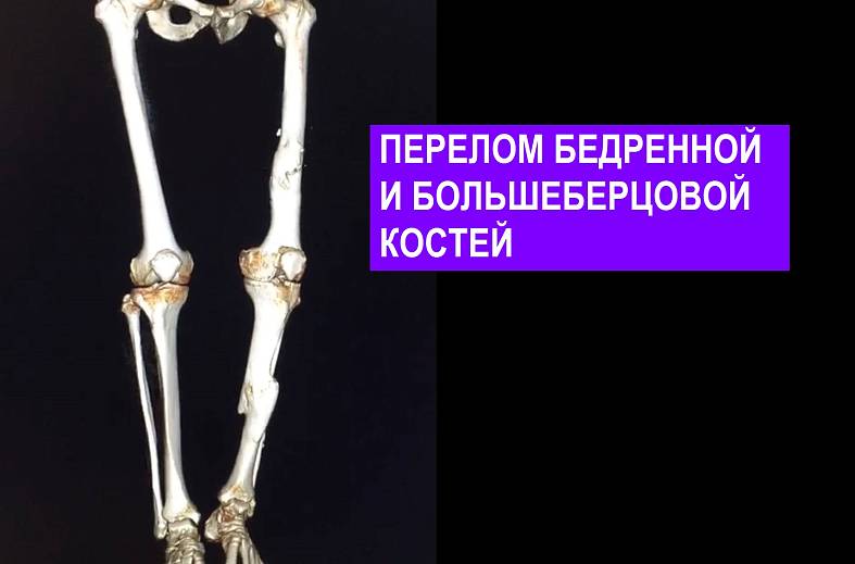КТ бедренной кости