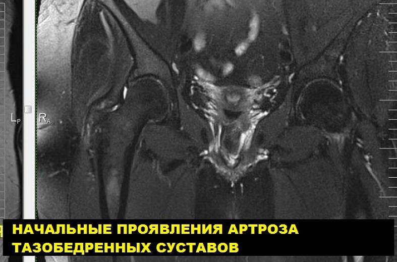 МРТ тазобедренных суставов (пара суставов)