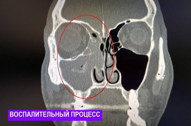 КТ придаточных пазух носа