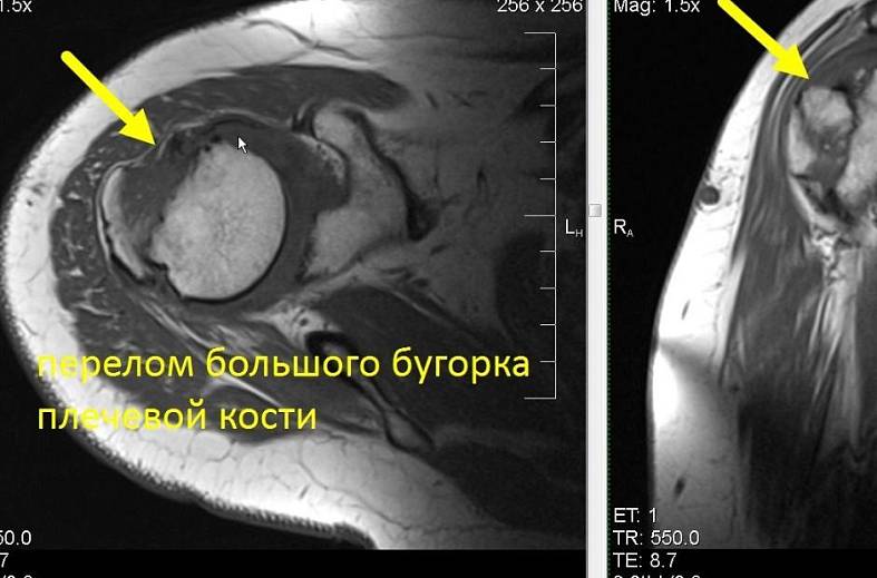 МРТ плечевого сустава