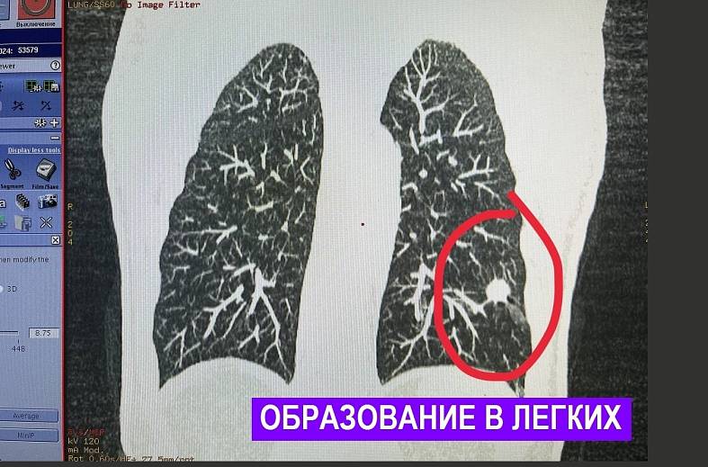 КТ флюорография