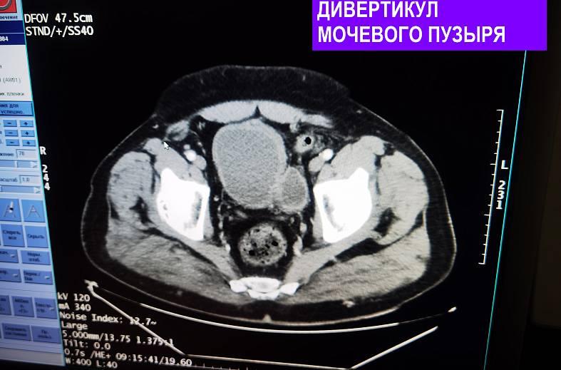 КТ малого таза (мужской: предстательная железа, семенные пузырьки, мочевой пузырь)