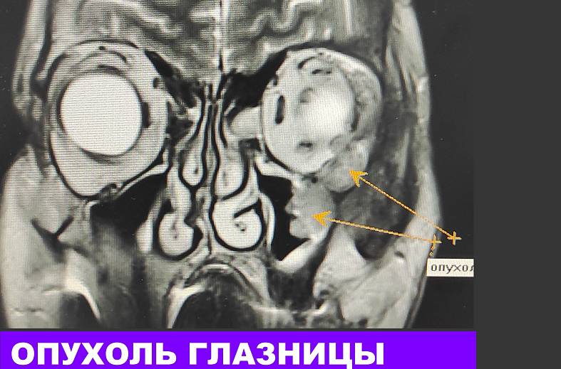 МРТ глазных орбит и зрительных нервов