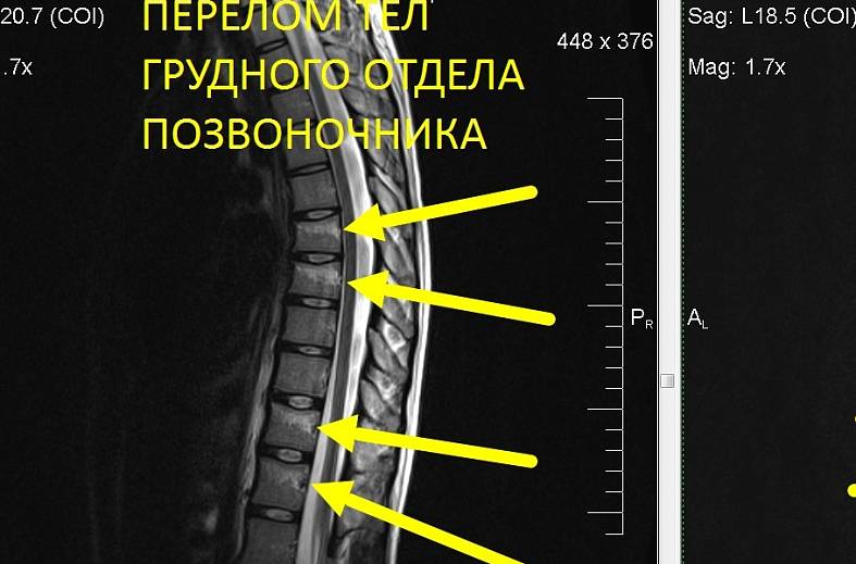 МРТ грудного отдела позвоночника