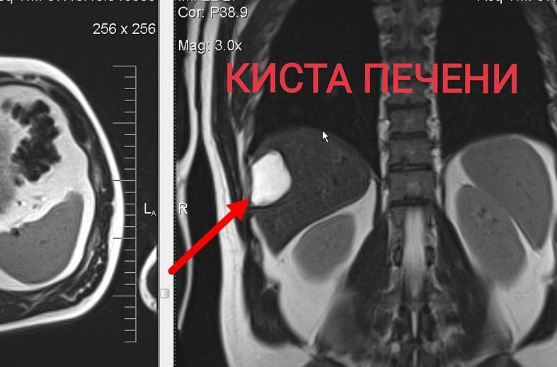 МРТ органов брюшной полости и холангиография (детальный осмотр внутри и вне печеночных желчных протоков)