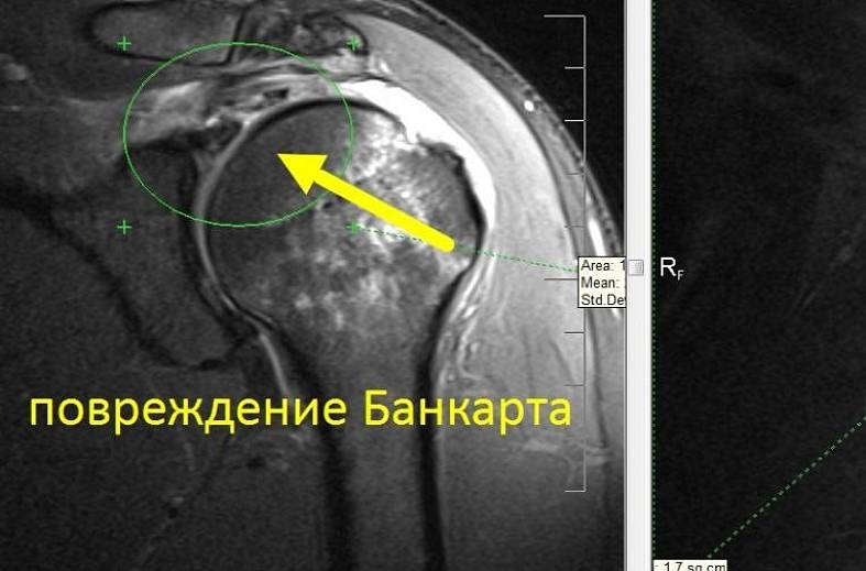 МРТ плечевого сустава