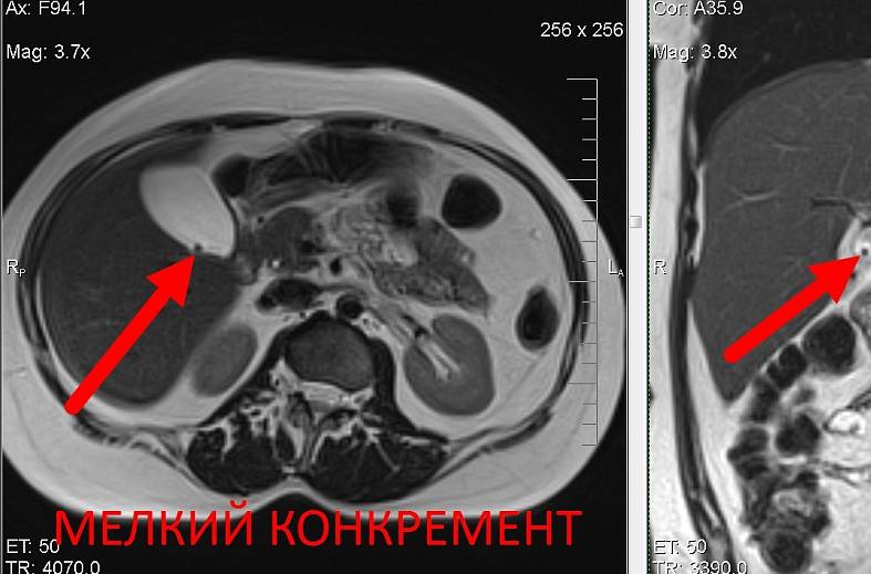 МРТ органов брюшной полости и холангиография (детальный осмотр внутри и вне печеночных желчных протоков)