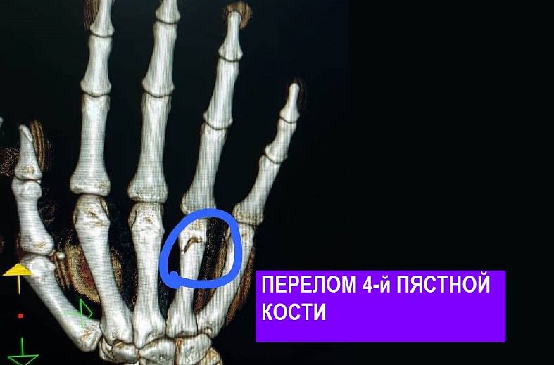 КТ кисти