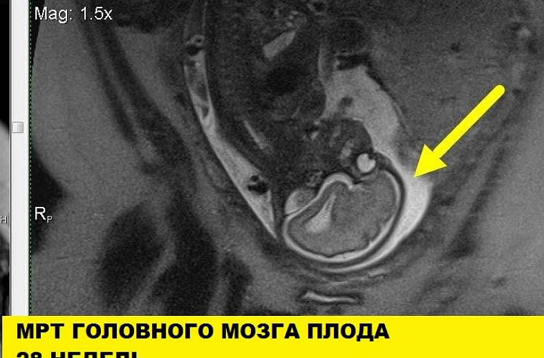 МРТ беременности с 22 недели (пороки развития плода, патология матери, определение пола)