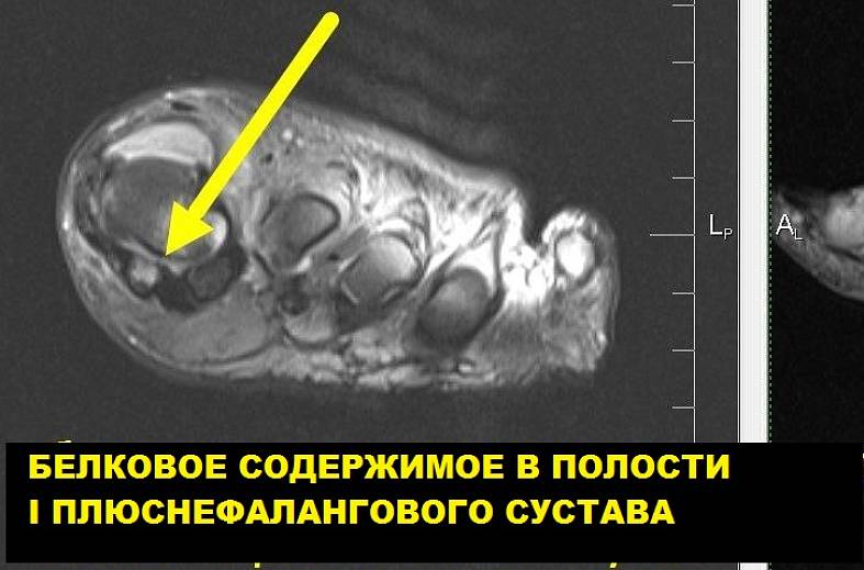 МРТ стопы