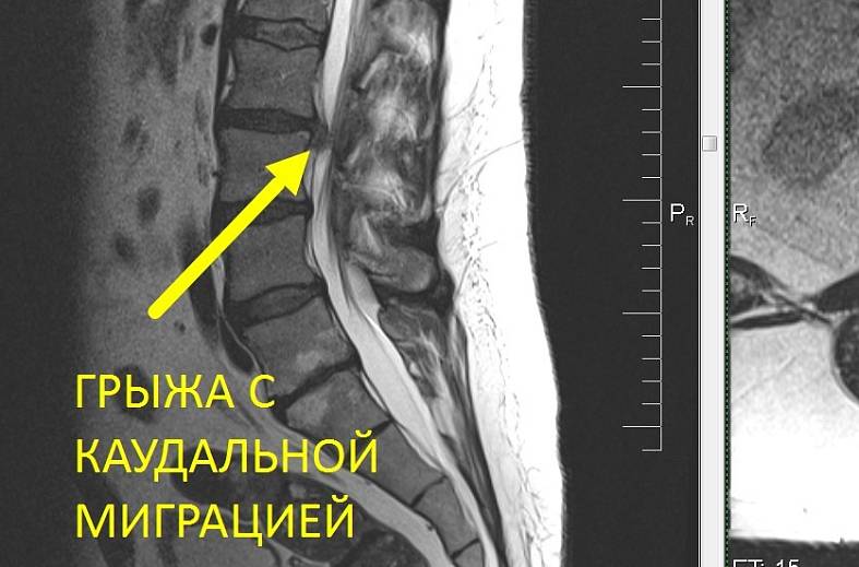 МРТ пояснично-крестцового отдела позвоночника