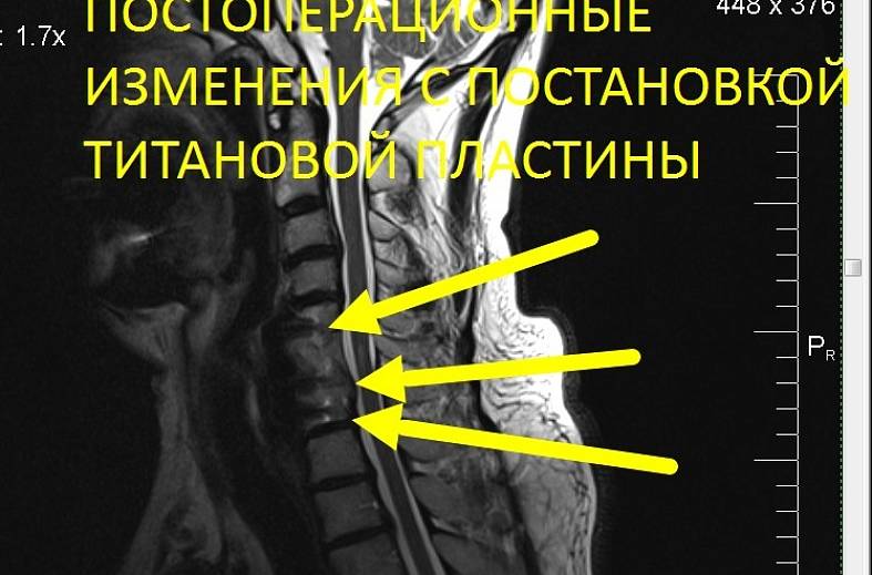 МРТ шейного отдела позвоночника