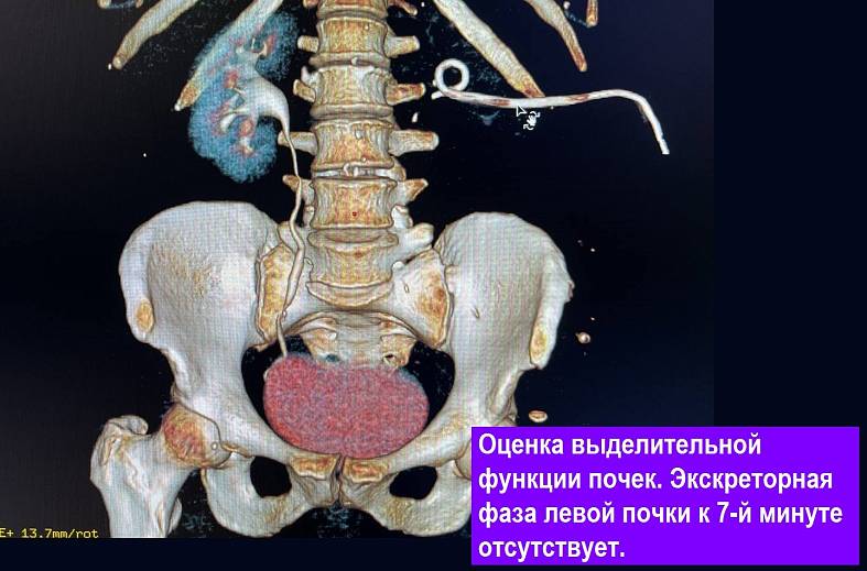 КТ мочевыводящих путей, экскреторная урография (почки, мочеточники, мочевой пузырь, лимфатические узлы)