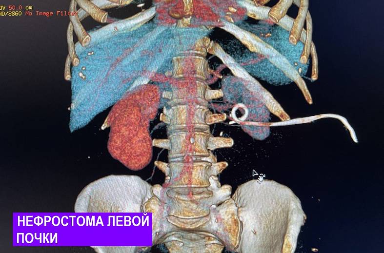 КТ мочевыводящих путей, экскреторная урография (почки, мочеточники, мочевой пузырь, лимфатические узлы)