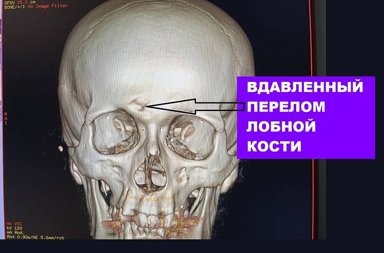 КТ костей черепа