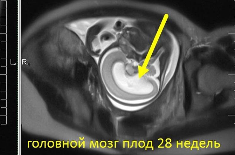 МРТ беременности с 22 недели (пороки развития плода, патология матери, определение пола)