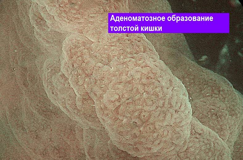 Видеоколоноскопия экспертного класса на аппарате Pentax i7010 (Япония) expert