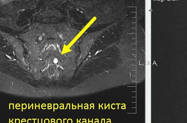 МРТ пояснично-крестцового и крестцово-копчикового отдела позвоночника