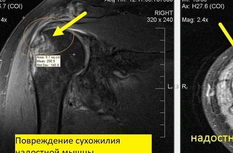 МРТ плечевого сустава
