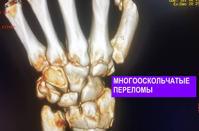 КТ кисти