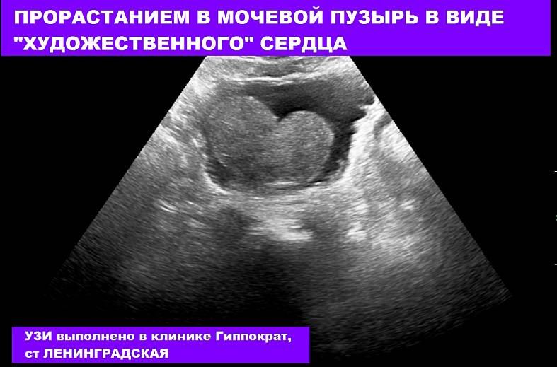УЗИ предстательной железы, простаты трансректальное (ТРУЗИ) на аппарате элитного класса