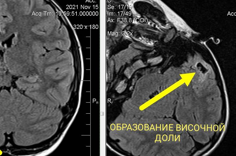 Высокопольная МРТ головного мозга по программе эпилептологического сканирования