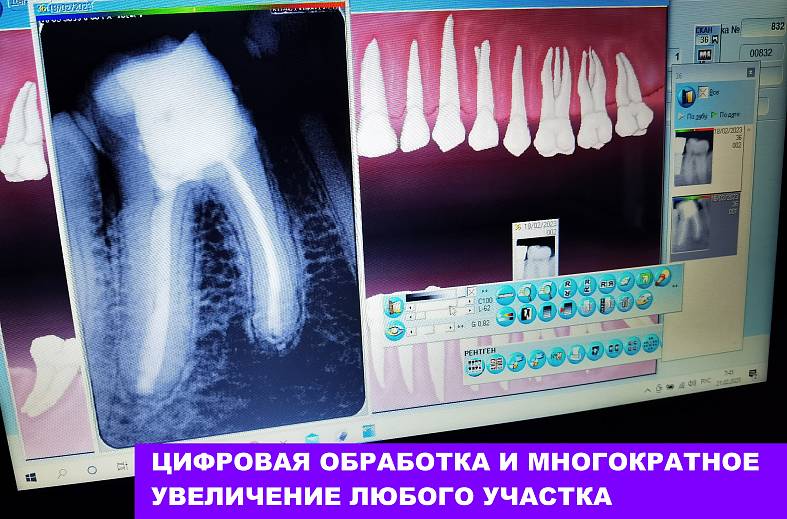 Снимок зуба - визиограмма